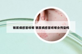 銀屑病感冒咳嗽 銀屑病感冒咳嗽會(huì)傳染嗎