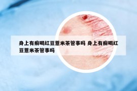 身上有癬喝紅豆薏米茶管事嗎 身上有癬喝紅豆薏米茶管事嗎