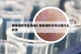 銀屑病懷孕能用維E 銀屑病懷孕可以用什么藥膏