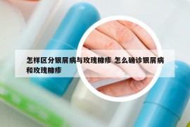 怎樣區(qū)分銀屑病與玫瑰糠疹 怎么確診銀屑病和玫瑰糠疹