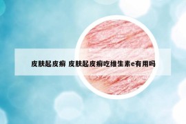 皮膚起皮癬 皮膚起皮癬吃維生素e有用嗎