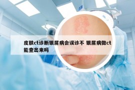 皮膚ct診斷銀屑病會誤診不 銀屑病做ct能查出來嗎