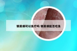 銀屑病可以魚療嗎 銀屑病能否吃魚