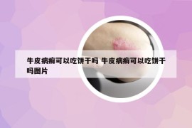 牛皮病癬可以吃餅干嗎 牛皮病癬可以吃餅干嗎圖片