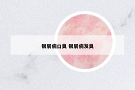 銀屑病口臭 銀屑病發(fā)臭