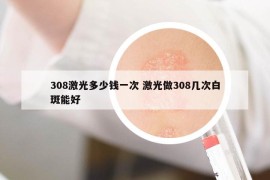 308激光多少錢一次 激光做308幾次白斑能好