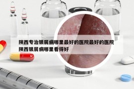 陜西專治銀屑病哪里最好的醫(yī)院最好的醫(yī)院 陜西銀屑病哪里看得好