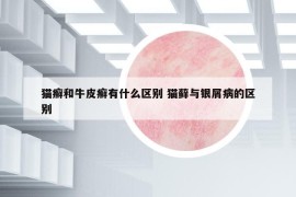 貓癬和牛皮癬有什么區(qū)別 貓?zhí)\與銀屑病的區(qū)別