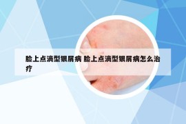 臉上點(diǎn)滴型銀屑病 臉上點(diǎn)滴型銀屑病怎么治療