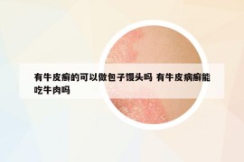 有牛皮癬的可以做包子饅頭嗎 有牛皮病癬能吃牛肉嗎