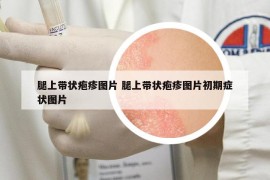 腿上帶狀皰疹圖片 腿上帶狀皰疹圖片初期癥狀圖片