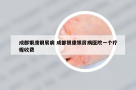 成都銀康銀屑病 成都銀康銀屑病醫(yī)院一個(gè)療程收費(fèi)