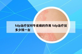 tdp治療儀對(duì)牛皮癬的作用 tdp治療儀多少錢一臺(tái)