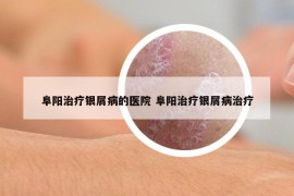 阜陽(yáng)治療銀屑病的醫(yī)院 阜陽(yáng)治療銀屑病治療