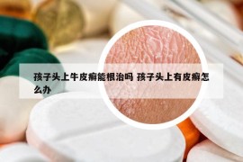 孩子頭上牛皮癬能根治嗎 孩子頭上有皮癬怎么辦
