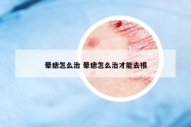 暈痣怎么治 暈痣怎么治才能去根