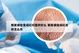 銀屑病包變成紅印是轉(zhuǎn)好么 銀屑病變成紅皮狀怎么辦