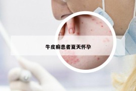 牛皮癬患者夏天懷孕