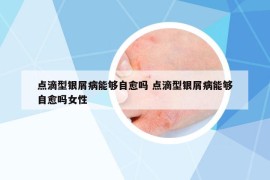 點滴型銀屑病能夠自愈嗎 點滴型銀屑病能夠自愈嗎女性