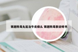 銀翹敗毒丸能治牛皮癬么 銀翹敗毒散說明書