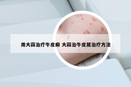 用大蒜治療牛皮癬 大蒜治牛皮屑治療方法