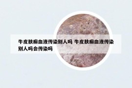 牛皮膚癬血液傳染別人嗎 牛皮膚癬血液傳染別人嗎會傳染嗎