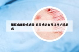 銀屑病用粉底遮蓋 銀屑病患者可以用護膚品嗎