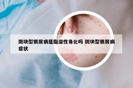 斑塊型銀屑病是脂溢性角化嗎 斑塊型銀屑病癥狀