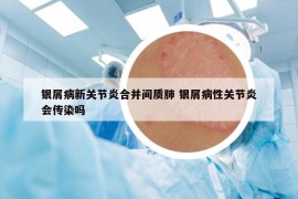 銀屑病新關(guān)節(jié)炎合并間質(zhì)肺 銀屑病性關(guān)節(jié)炎會傳染嗎