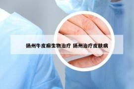 揚(yáng)州牛皮癬生物治療 揚(yáng)州治療皮膚病