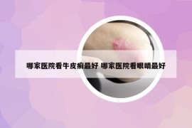 哪家醫(yī)院看牛皮癬最好 哪家醫(yī)院看眼睛最好