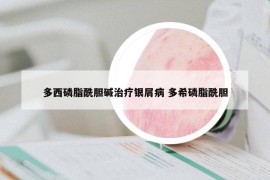 多西磷脂酰膽堿治療銀屑病 多希磷脂酰膽