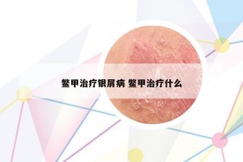 鱉甲治療銀屑病 鱉甲治療什么