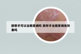 膚幫手可以治銀屑病嗎 膚邦手治銀屑病有效果嗎