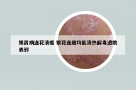 銀屑病連花清瘟 銀花連翹均能清熱解毒透散表邪
