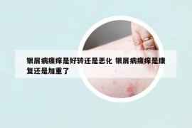 銀屑病瘙癢是好轉(zhuǎn)還是惡化 銀屑病瘙癢是康復(fù)還是加重了