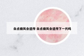 白點(diǎn)癲風(fēng)會(huì)遺傳 白點(diǎn)癲風(fēng)會(huì)遺傳下一代嗎