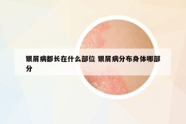 銀屑病都長(zhǎng)在什么部位 銀屑病分布身體哪部分