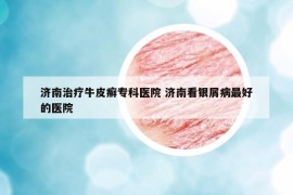 濟(jì)南治療牛皮癬?？漆t(yī)院 濟(jì)南看銀屑病最好的醫(yī)院