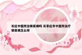石莊中醫(yī)院治銀屑病嗎 石家莊市中醫(yī)院治療銀屑病怎么樣