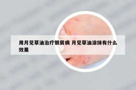 用月見草油治療銀屑病 月見草油涂抹有什么效果