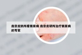 南京皮防所看銀屑病 南京皮研所治療銀屑病的專家