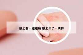 腰上有一道道癬 腰上長(zhǎng)了一塊蘚