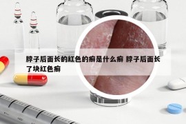 脖子后面長(zhǎng)的紅色的癬是什么癬 脖子后面長(zhǎng)了塊紅色癬