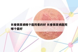 長春銀屑病哪個(gè)醫(yī)院看的好 長春銀屑病醫(yī)院哪個(gè)最好