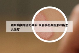 銀屑病初期圓形紅癬 銀屑病初期圓形紅癬怎么治療