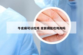 牛皮癬可以吃雞 皮膚病能吃雞肉嗎
