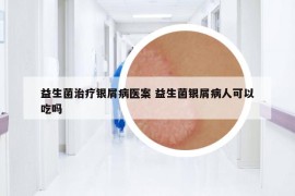 益生菌治療銀屑病醫(yī)案 益生菌銀屑病人可以吃嗎
