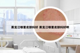 黑龍江哪里皮膚科好 黑龍江哪里皮膚科好啊