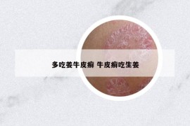 多吃姜牛皮癬 牛皮癬吃生姜